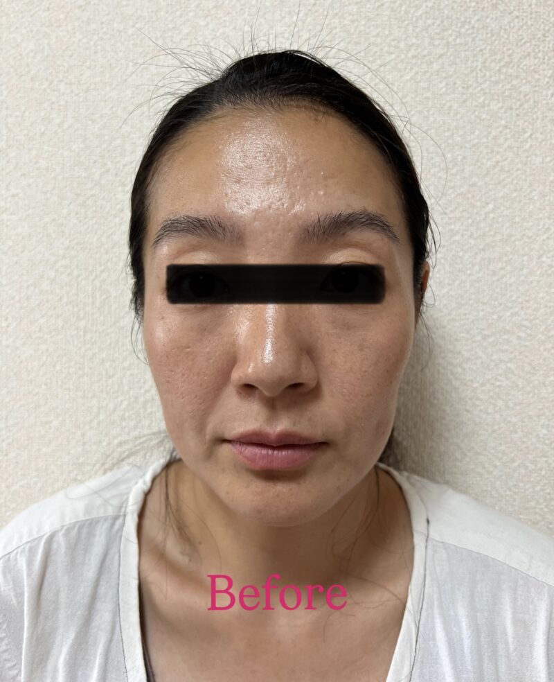 Before-and-after comparison showing the effects of a neck lymphatic massage. The left image shows before treatment, and the right shows after, with a visibly slimmer and more defined facial line