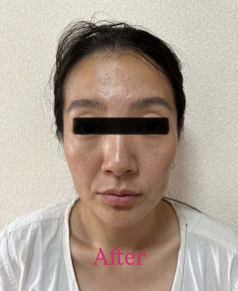 Before-and-after comparison showing the effects of a neck lymphatic massage. The left image shows before treatment, and the right shows after, with a visibly slimmer and more defined facial line